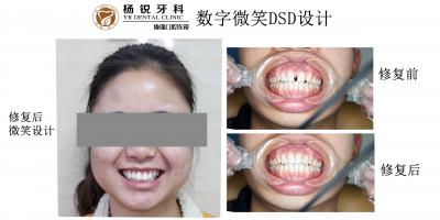 DSD微笑修復案例4